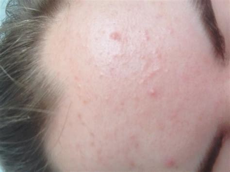 Please Help Forehead Bumps General Acne Discussion Acne Org Forum