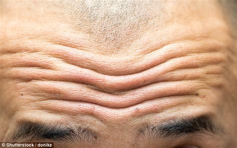 deep forehead wrinkles early sign of cardiovascular disease according to german scientists