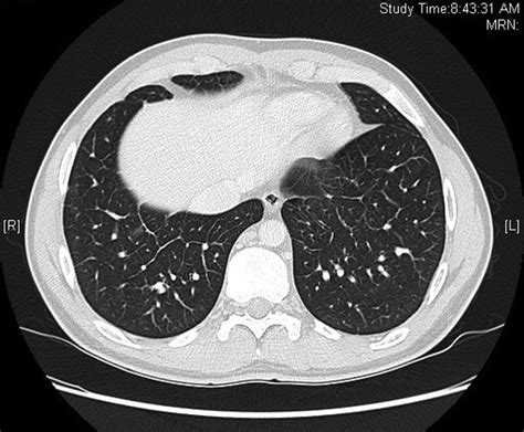 Pulmonary Veno Occlusive Disease An Uncommon Cause Of Pulmonary