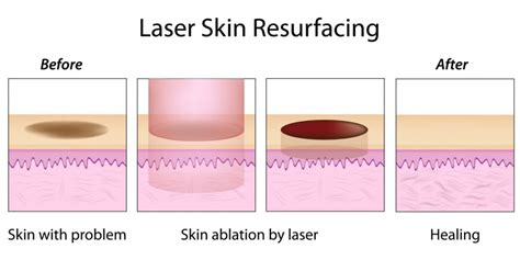 Laser Skin Resurfacing Anewskin Aesthetic Clinic And Medical Spa Dc