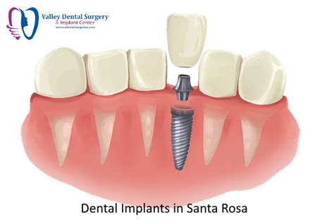 Dental Implant Cost Santa Rosa Ca How Much Is Dental Implant