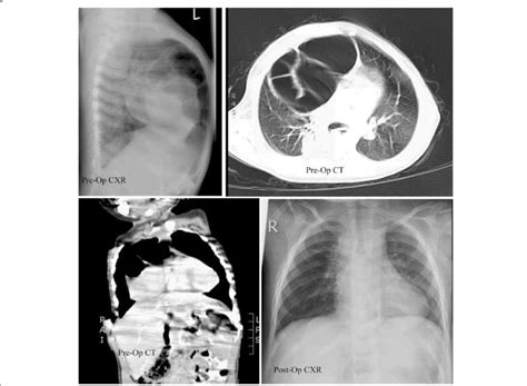 A Lateral Chest X Ray Of A Case Of Morgagni Hernia B And C Ct Chest