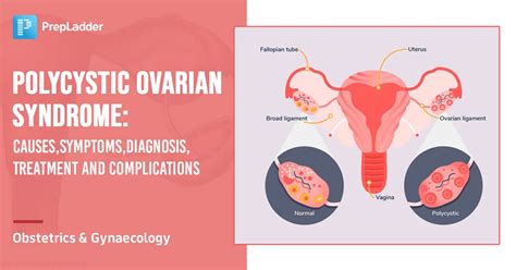 Polycystic Ovarian Syndrome Pcos Causes Symptoms Diagnosis