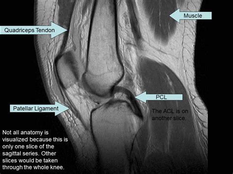 Knee Muscle Anatomy Mri Smartview Co Wp Content Uploads 2014