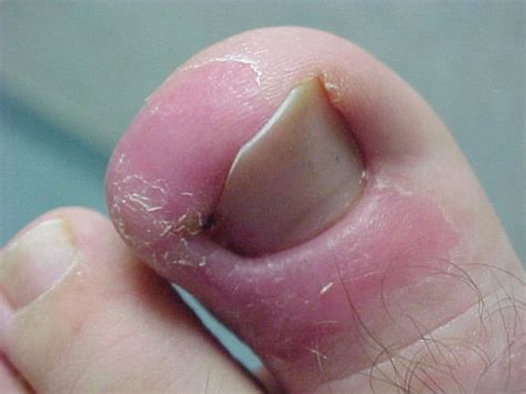 Infected Toenail Pictures Photos
