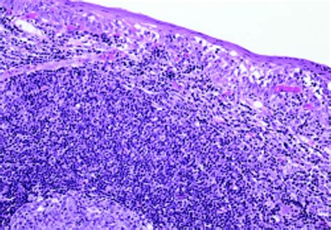 Mucosa Associated Lymphoid Tissue Pdf Cystic Changes In Mucosa