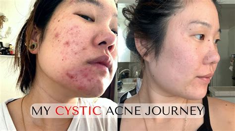 How I Treated My Cystic Hormonal Adult Acne Youtube