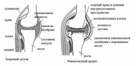 Ревматоидный полиартрит диета при полиартрите Ревматоидный артрит. Симптомы, лечение - Клиника Здоровье 365 г Ревматоидный артрит. Симптомы, лечение - Клиника Здоровье 365 г Ревматоидный полиартрит диета при полиартрите