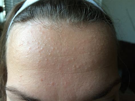 Skin Concerns Bumps All Over My Hair Hairloss Rskincareaddiction