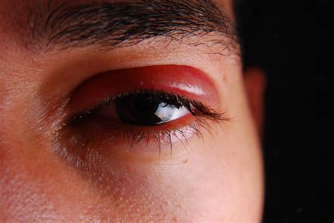 Herpes Zóster En El Ojo Síntomas Tratamiento Y Prevención Salud Tudo