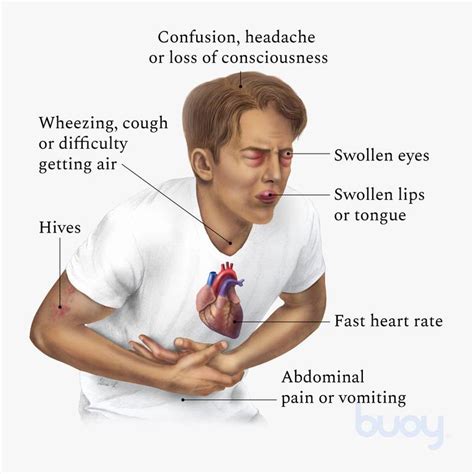 Signs And Symptoms Of Severe Allergic Reaction And Anaphylaxis