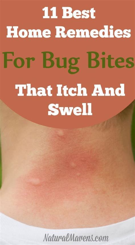 11 Best Home Remedies For Bug Bites That Itch And Swell Remedies For Mosquito Bites Bug Bite