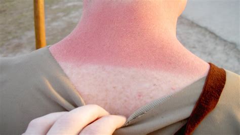 How To Get Rid Of Peeling Skin After Sunburn Skin Peeling Sunburn