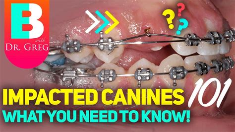 Braces And Impacted Canines Youtube