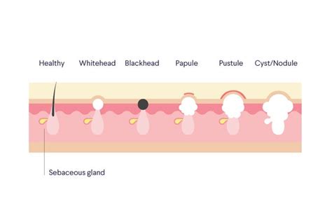 Types Of Acne Blackheads Whiteheads And Beyond By Curology Team