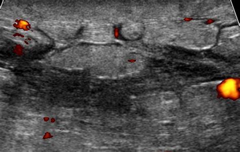 Sonographic Features Of Inflammatory Conditions Of The Breast Febery