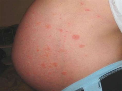 Puppp Rash In Pregnancy Natural Treatments And Prevention No Health