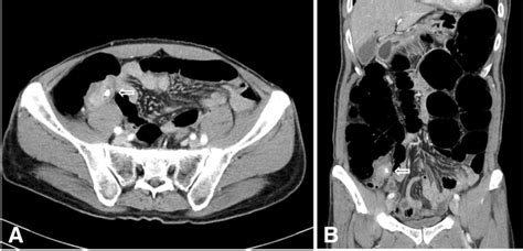 Appendiceal Intussusception Requiring An Ileocecectomy A Case Report