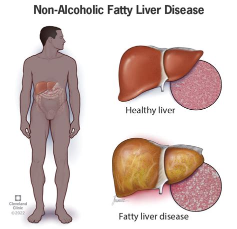 What Is Metabolic Dysfunction Associated Steatotic Liver Disease