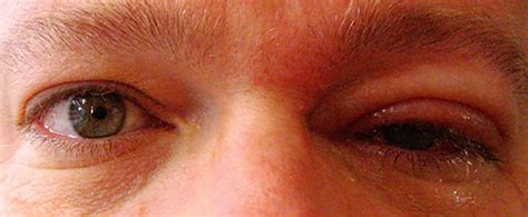 Shingles In The Eye Symptoms Complications And More Sexiezpix Web Porn