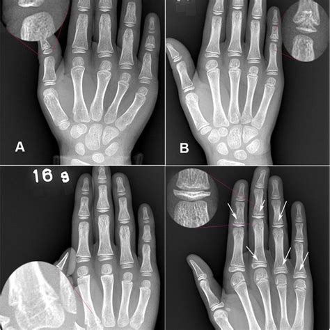 A Is A Radiological Image Of The Right Hand With Kbd Positive X Ray