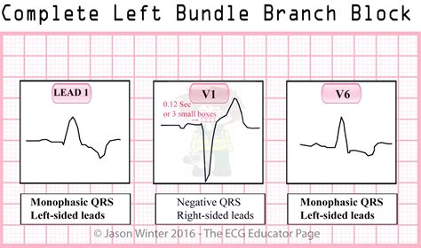 Right And Left Bundle Branch Block