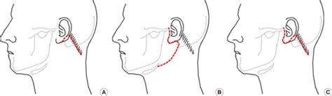 Types Of Incsion For Parotid Tumor A Retroauricular Hair Line