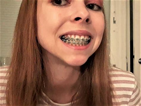 pin by j t on braces cute braces braces girls teeth braces