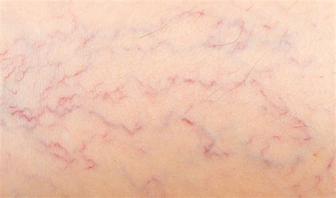 Causes Of Varicose Veins In Arms And Hands By Melbourne Experts