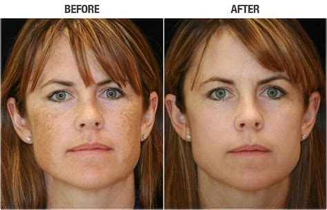 Laser Skin Resurfacing in Los Angeles - Laser Skin Rejuvenation