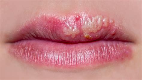 Cold Sore And Swelling Lips Sitelip Org