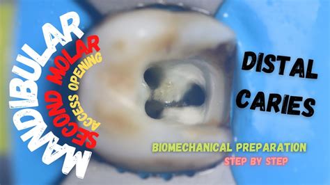 Access Opening In Mandibular Second Molar With Distal Caries Youtube
