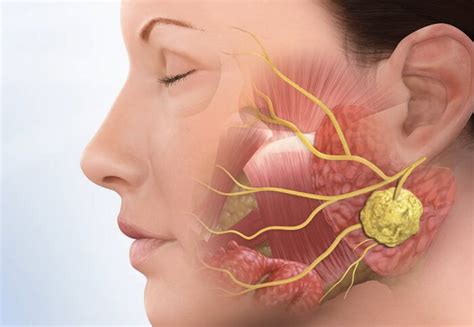 Se habla de adenoma pleomorfo. كل ما تحتاج إلى معرفته عن ورث وارثين - بالعربي