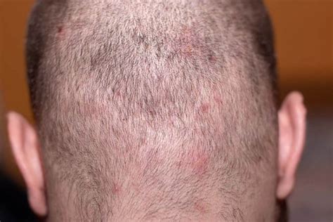 Red Blotches And Reddened Scalps What Can Be Done Alpecin