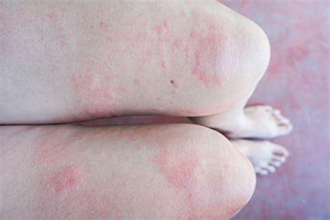 Skin Conditions That Mimic Chronic Hives