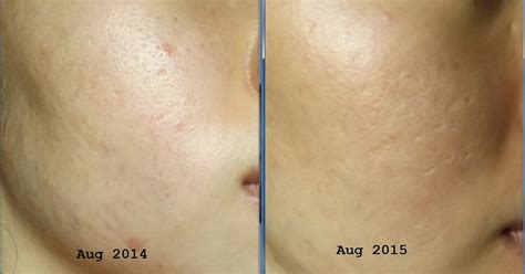 [treatment] Depressed Acne Scars After Dermarolling At Home Cindity