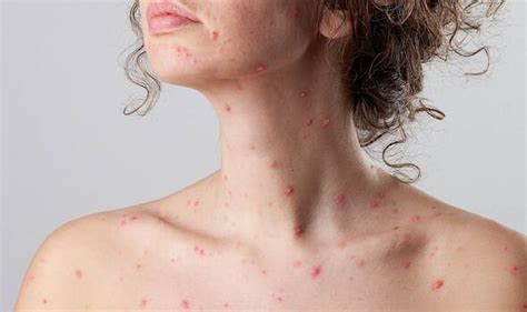 Shingles Symptoms 4 Key Signs That Are Different From Chickenpox