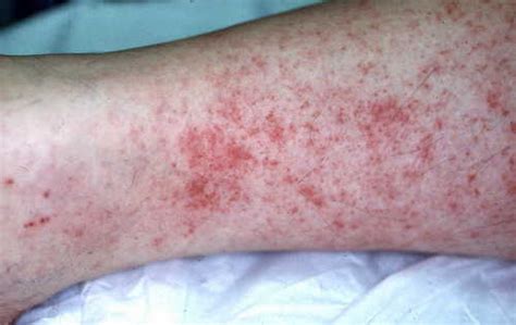 Healthoolrickettsial Pox Rash Pictures Atlas Of Rashes Associated With
