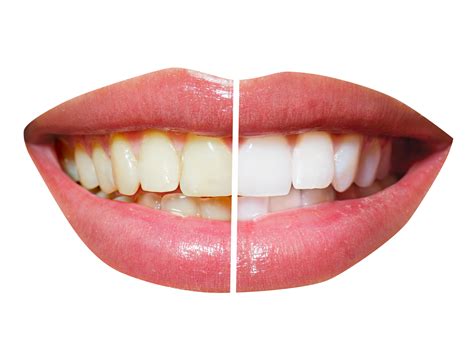 Transparent Tooth Images Reverse Search