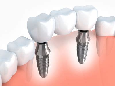 Dental Implant Procedure Painless Tooth Implant Cost In India