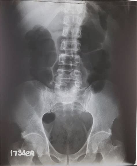 X Ray Abdomen Supine Showing Dilated Ascending And Descending Colon