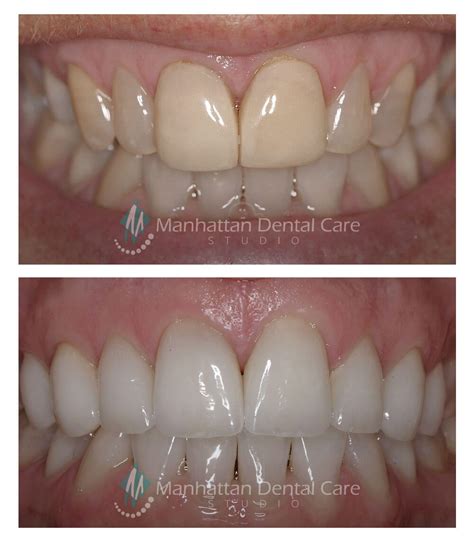 Esthetic Dental Crowns Redondo Beach Manhattan Dental Care Studio