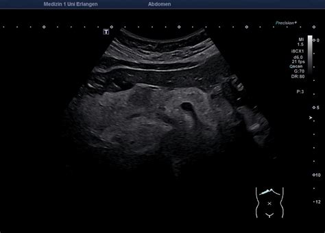 Cystic Tumor Atlas Of Ultrasound