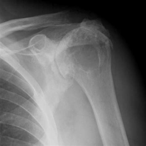 Preoperative Image Of The Fistulized Acromioclavicular Joint Cyst