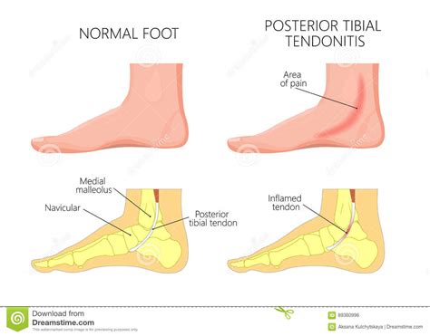 Medial Ankle Injuryposterior Tibial Tendon Rupture Vector Illustration