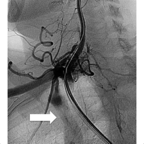 Selective Right Subclavian Artery Angiogram Revealing The Fistulous