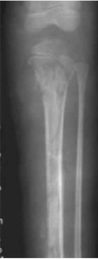 X Ray Plain Film Scanning Image Of Acute Suppurative Osteomyelitis Of