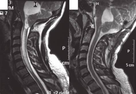 T2 Weighted Sagittal Magnetic Resonance Imaging Shows Dilated Fourth