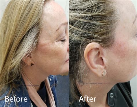 Lymph Drainage Lymphatic Face Before And After Best Drain Photos