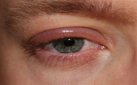 Secreción Ocular Clínica Isv